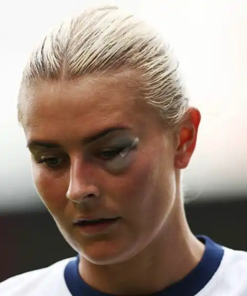 Violento scontro in campo, la calciatrice ha rischiato l’occhio. Le foto