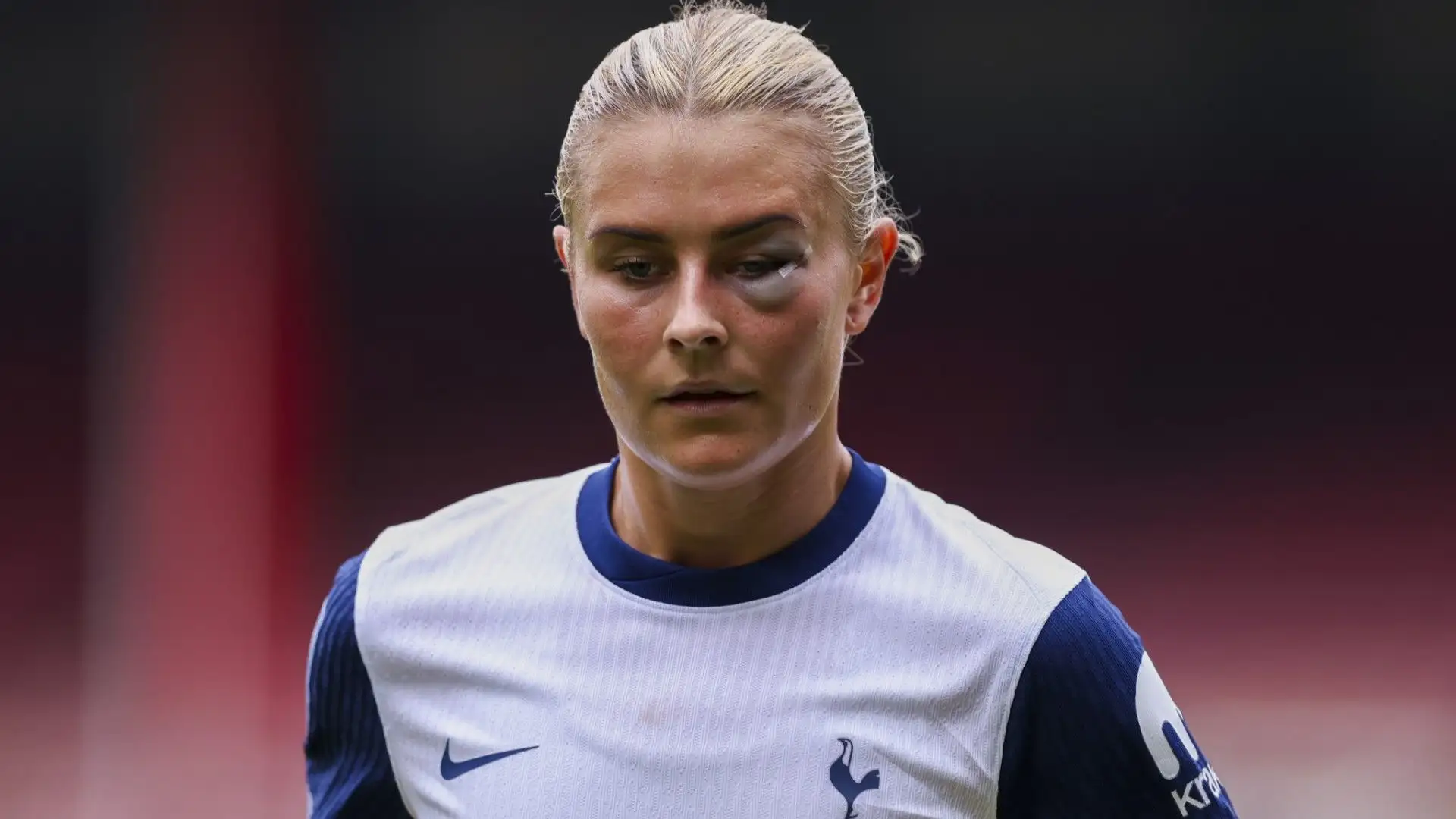 La calciatrice ha ricevuto un brutto colpo all'occhio nella partita contro il Crystal Palace
