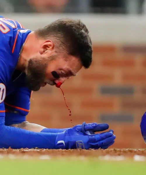 Pallina sul naso a oltre 150 km/h: le foto del campione sfigurato