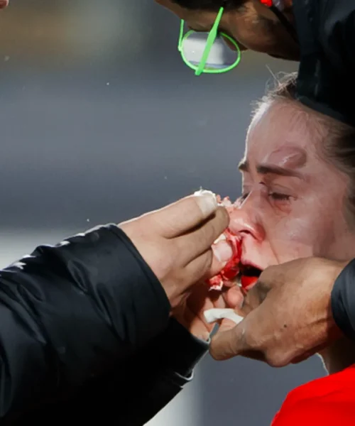 Calciatrice sfigurata dopo il terribile colpo in faccia: le foto